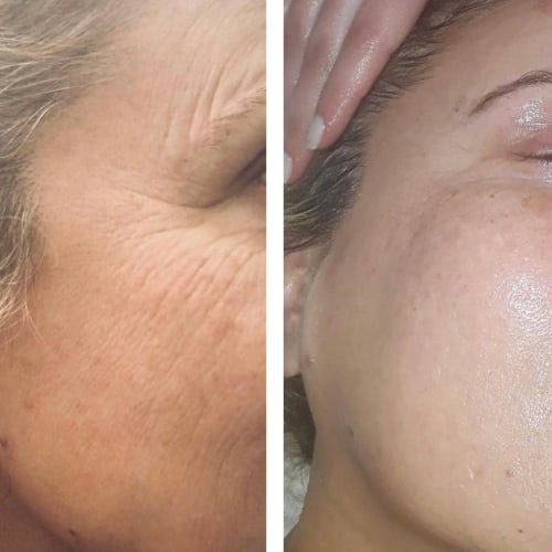 Vorher/Nachher – Faltenreduktion